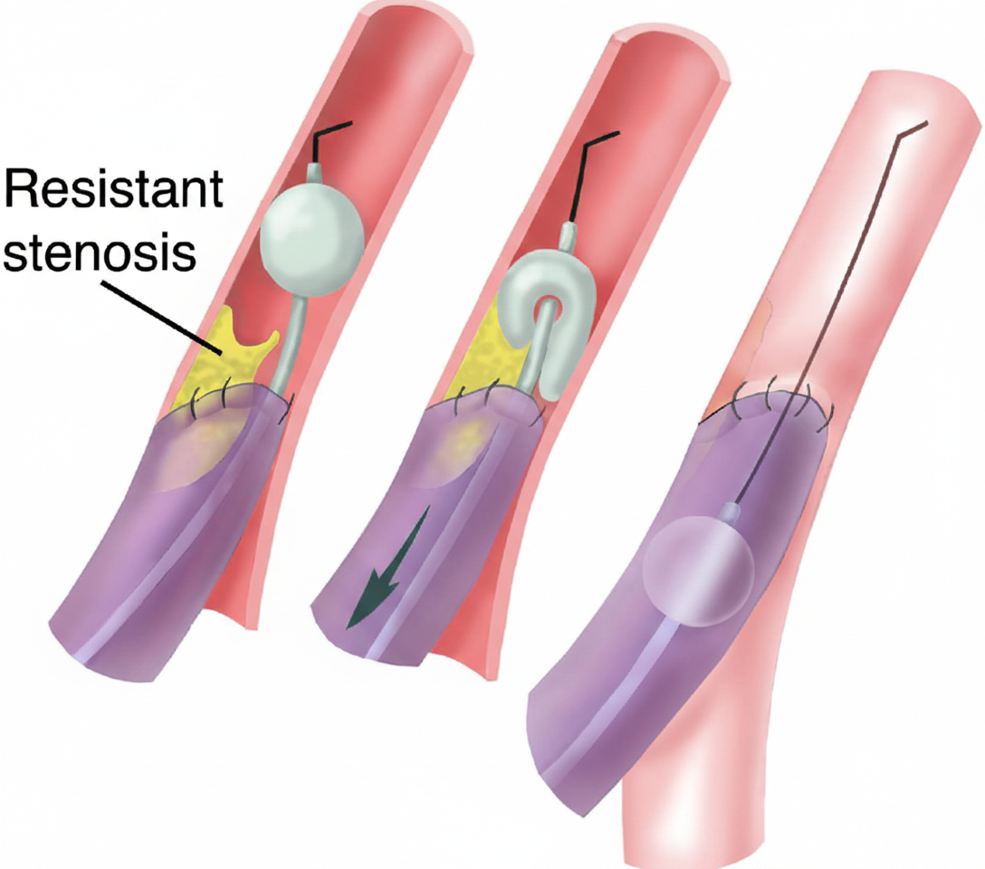 Complication Treatment